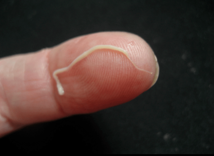 ปรสิตพยาธิตัวกลมออกจากร่างกายมนุษย์